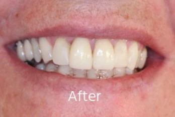 After Cosmetic Dentistry Case 2