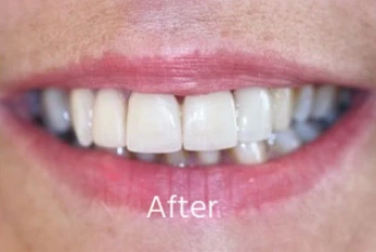 After Cosmetic Dentistry Case 3