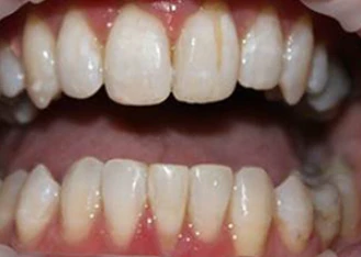 After Invisalign Alignment Transformation 1