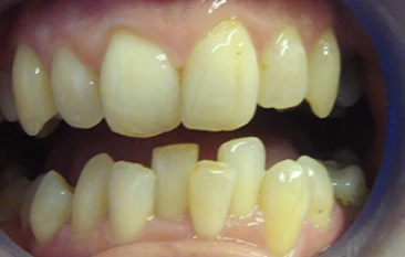 Before Invisalign Alignment Transformation 1