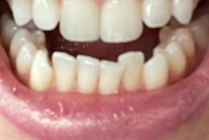Before Invisalign Alignment Transformation 2