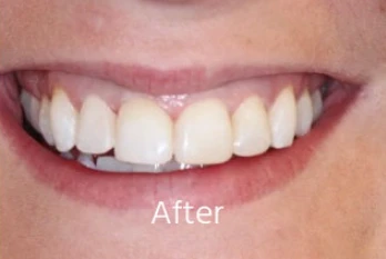 After Teeth Straightening Transformation 3